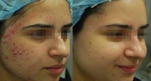 Fractora Treatment for Acne