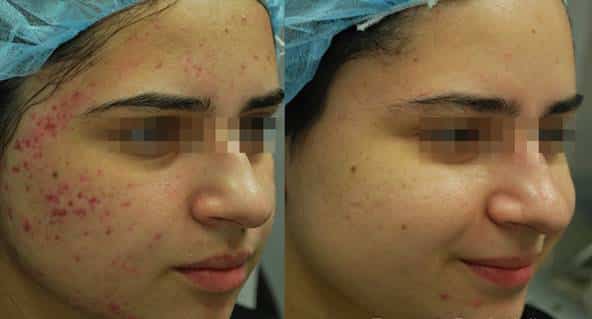 ACNE treatment with fractora
