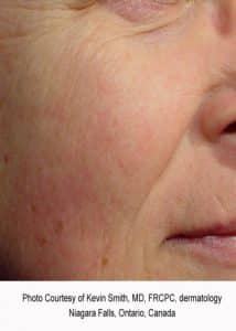 After Limelight Treatment for Facial Redness