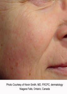 Facial Redness After Treatment