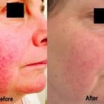 rosacea treatment - before and after pictures