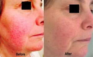 Before & After Sun Damaged Skin Treatment