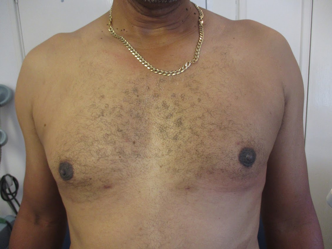 Bodytite liposuction 4 weeks after procedures