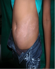 After Vitiligo Treatment on Stomach