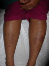 After Vitiligo Treatment