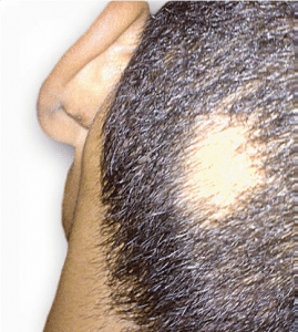 ExSys Excimer Laser for Alopecia Areata