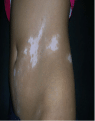 Before Vitiligo Treatment on Stomach