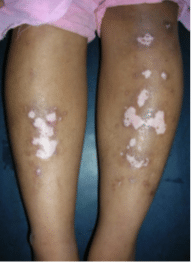 Before Vitiligo Treatment