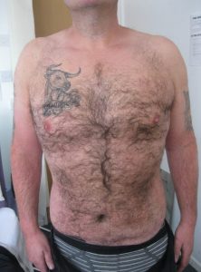 Results of Gynaecomastia Treatment