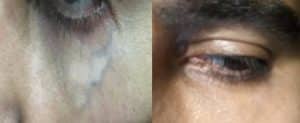 Laser Under Eye Vein Removal