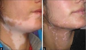 Neck Vitiligo (Before and After Treatment)