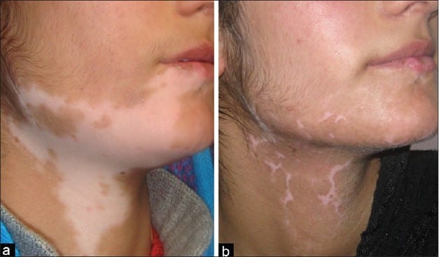 Vitiligo treatment in neck and face area