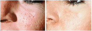 Before & After Dermaroller Micro Needling