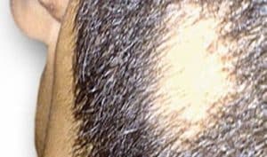 alopecia aerata treatment