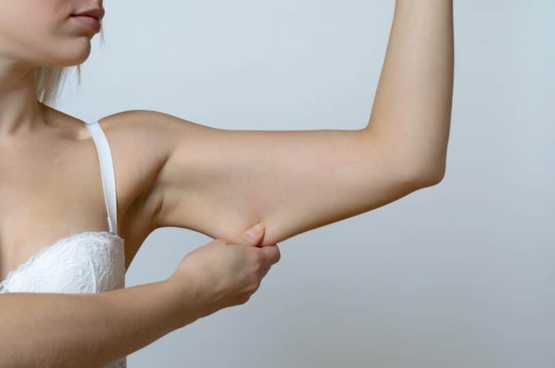 Lady showing her arm armtite liposuction