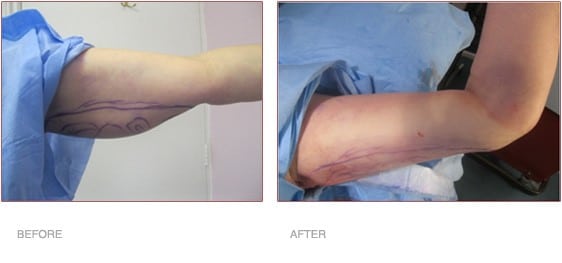 before and after results of armtite liposuction