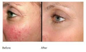 Facial Redness - Before and After