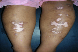 Before ExSys Excimer Laser Treatment for Vitiligo