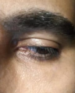 After Under Eye Laser Vein Removal Treatment
