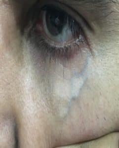 Before Under Eye Laser Vein Removal Treatment