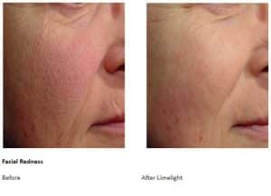 Facial Redness - Before and After