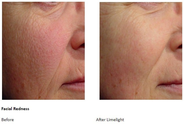 Before and After Limelight Treatment
