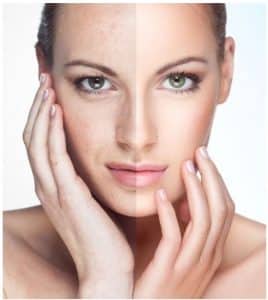 Limelight - Before and After Skin Treatment
