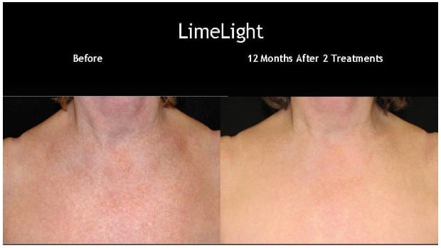 LimeLight - Before and After