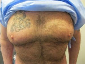 Before Male Breast Reduction Treatment