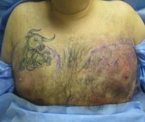 After Male Breast Reduction Treatment