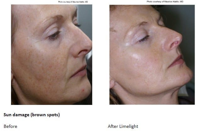 Before and After Limelight Treatment