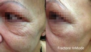 Eye Lift - Before and After