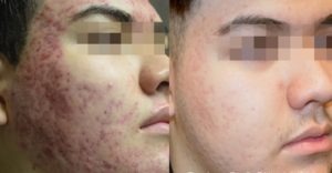 Before & After Fractora Treatment for Acne