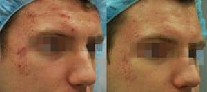 Before & After Fractora Treatment For Acne