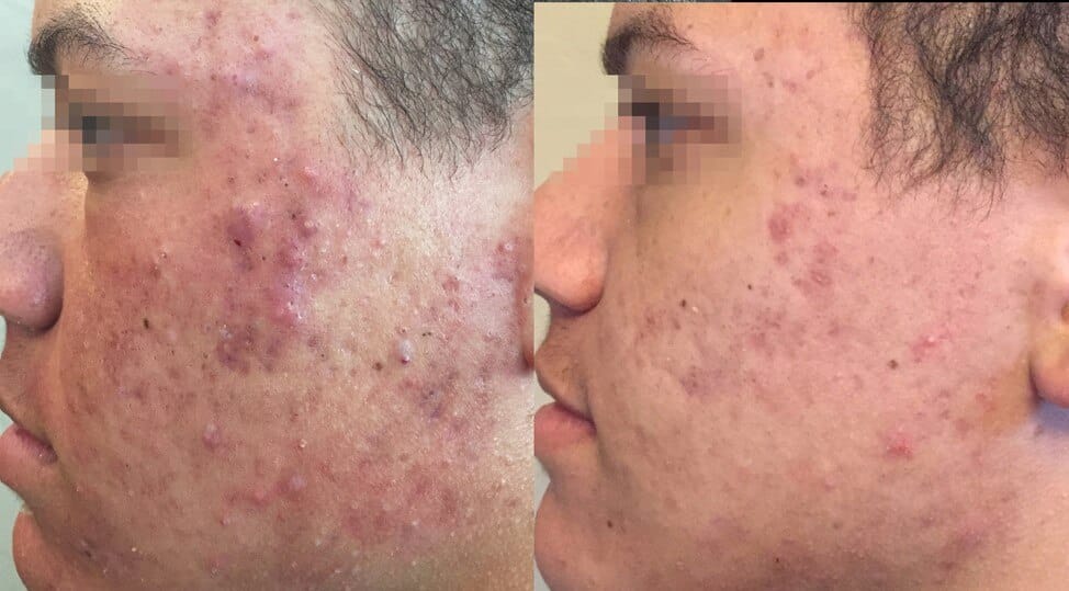 acne treatment at Solihull Medical Cosmetic Clinic