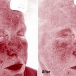 Before and After Rosacea Treatment Under UV Light