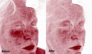 UV Comparison Before & After Rosacea Treatment