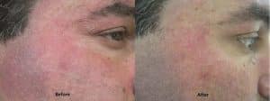 Before & After Laser Treatment for Rosacea