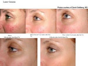 Before & After Each Laser Genesis Treatment for Rosacea