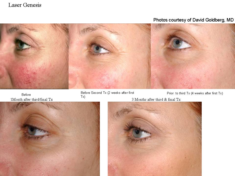 Before and After Laser Genesis