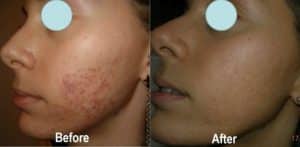 Before & After Rosacea Treatment