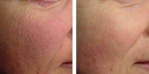 Before & After Rosacea Treatment for Sun Damaged Skin