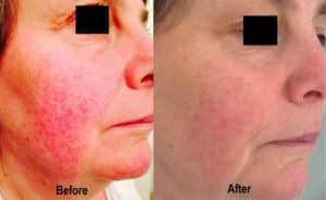 Before & After Rosacea Treatment