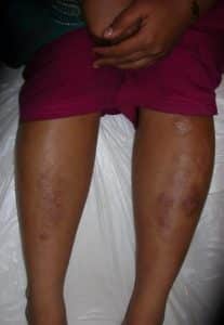 Treating Scars on Legs Using Hypopigmentation Treatment