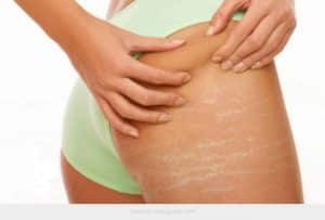 Hypopigmentation Clinic Treating Stretch Marks