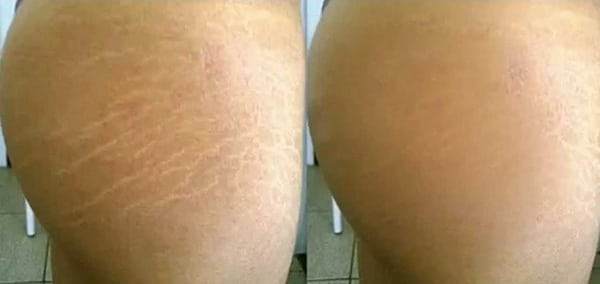 stretch marks treatment before and after