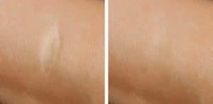 Before & After Hypopigmentation Clinic Treating Scarring