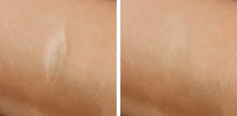 scars skin treatment