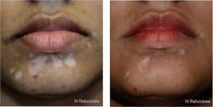 Before & After Hypopigmentation Clinic