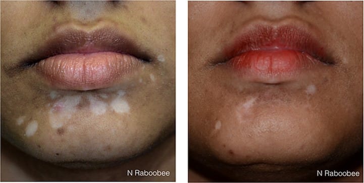 Before and After Laser Treatment for Vitiligo